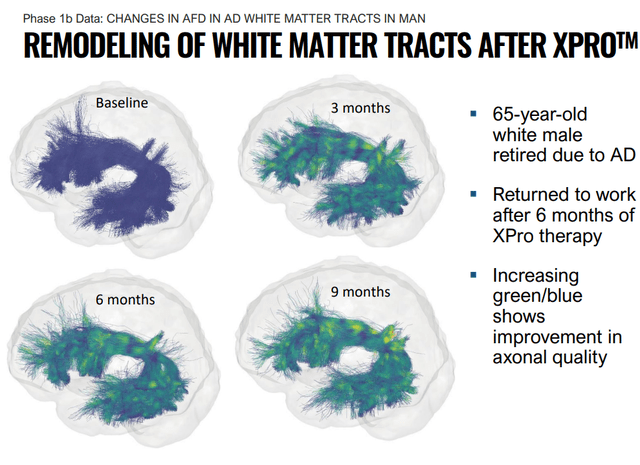 White matter improvement after Xpro