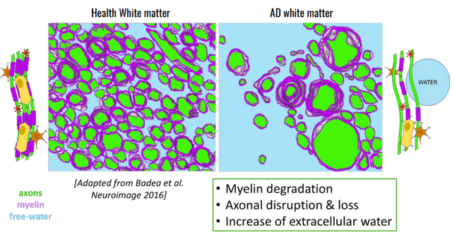 White Matter Free Water difference